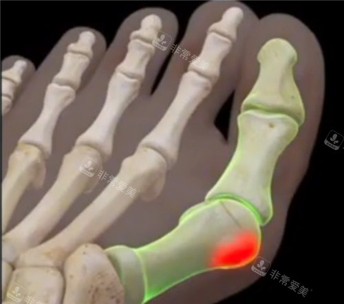 大腳骨示意圖 大腳骨示意圖