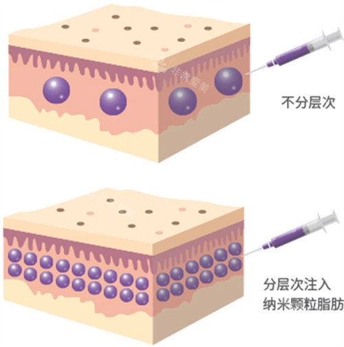 分層次脂肪填充圖片