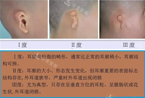 小耳畸形程度展示图 小耳畸形程度展示图
