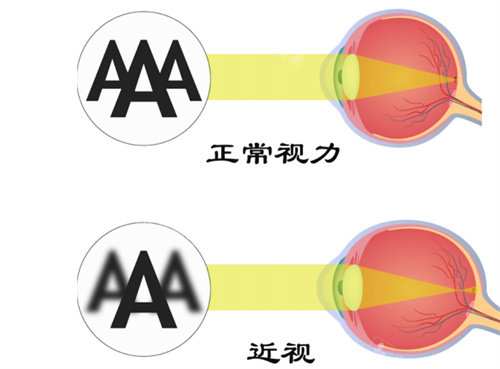 正常視力與近視對比圖 正常視力與近視對比圖