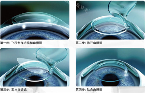 近視矯正手術(shù)流程圖 近視矯正手術(shù)流程圖