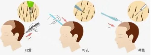 植发示意图 植发示意图