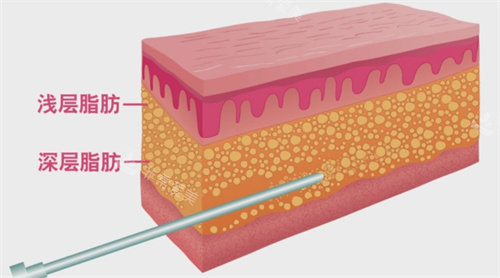 深层脂肪与浅层脂肪分布图