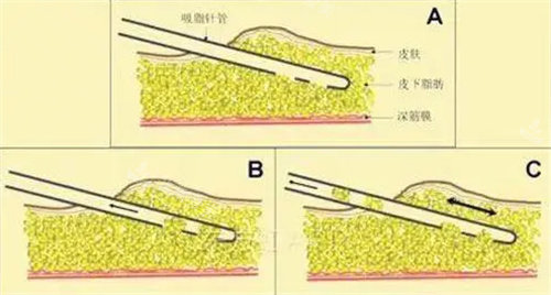 吸脂手術流程圖 吸脂手術流程圖