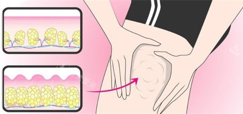 吸脂瘦大腿動畫圖 吸脂瘦大腿動畫圖