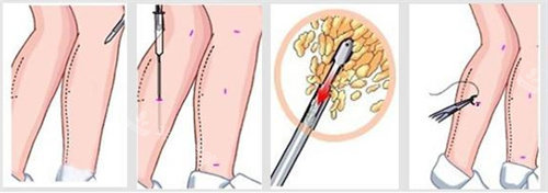 吸脂瘦小腿操作流程图