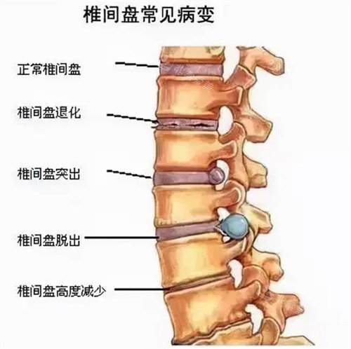 腰椎盘病变图