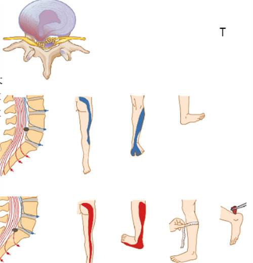 椎间盘症状图