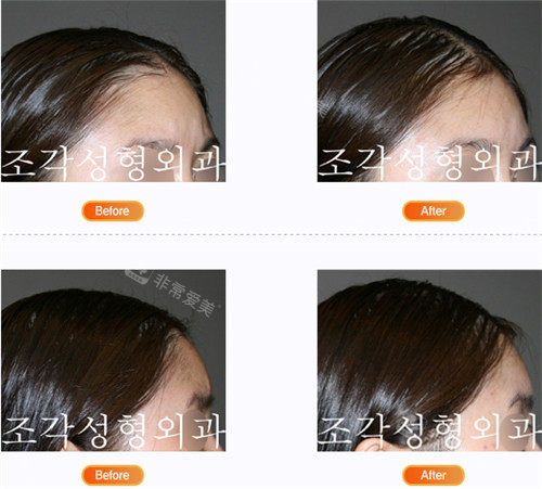 韩国雕刻整形头顶填充手术照片