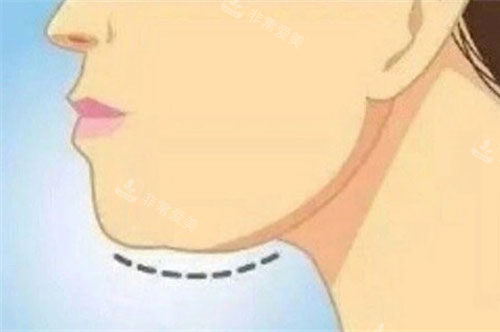 下颌缘提升动画图