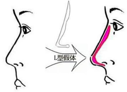 L型假體圖