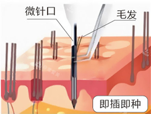 无痕植发示意图