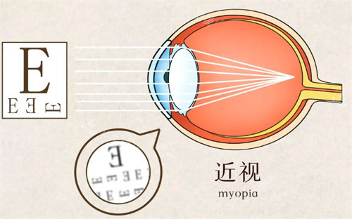 近视了，做全飞秒近视术好吗？