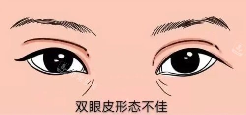 雙眼皮形態(tài)問(wèn)題示意圖 雙眼皮形態(tài)問(wèn)題示意圖