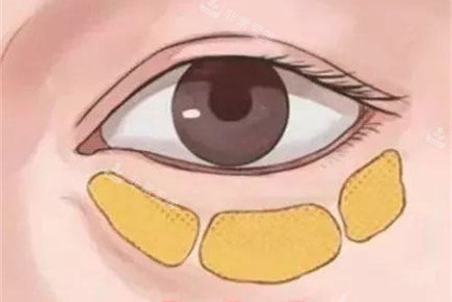 眼袋构成图