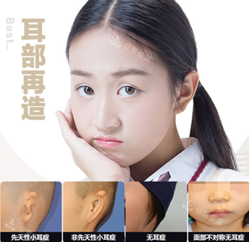 韓國普羅菲耳耳再造技術怎么樣? 韓國普羅菲耳耳再造技術怎么樣?