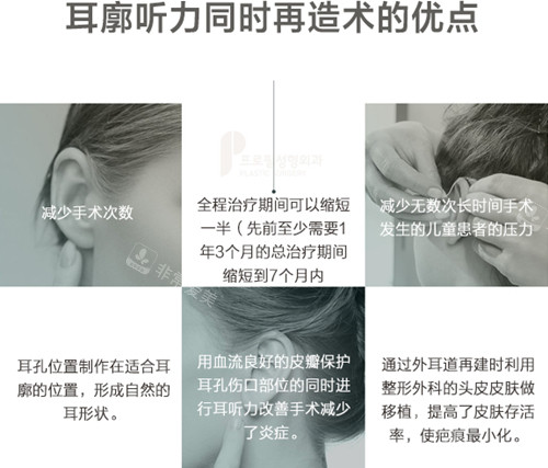 韓國普羅菲耳耳再造技術優(yōu)勢 韓國普羅菲耳耳再造技術優(yōu)勢
