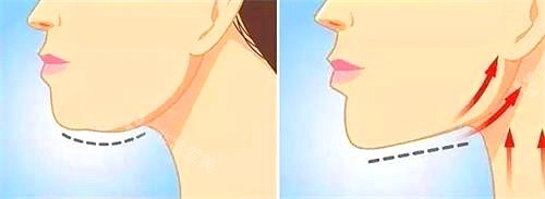 拉皮前后動(dòng)畫圖