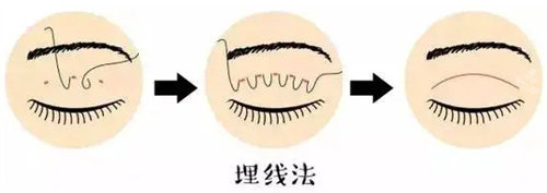 埋線雙眼皮圖