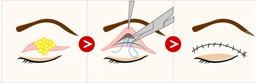 双眼皮修复流程图