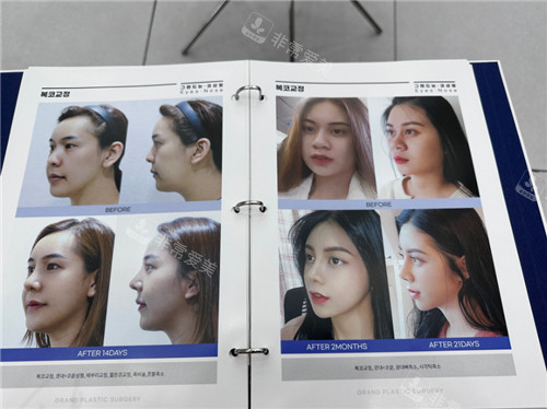韓國高蘭得整形外科真人實(shí)例圖冊展示 韓國高蘭得整形外科真人實(shí)例圖冊展示
