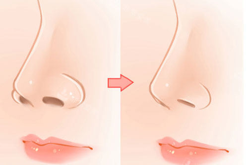 玻尿酸填充鼻基底会移位吗？