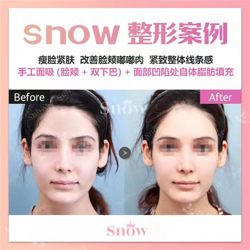韓國Snow醫(yī)院面部吸脂對比 韓國Snow醫(yī)院面部吸脂對比