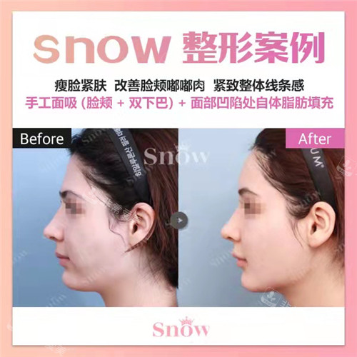 韓國Snow醫(yī)院面吸+脂肪填充前后圖 韓國Snow醫(yī)院面吸+脂肪填充前后圖