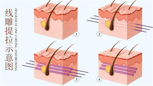 埋線(xiàn)提升術(shù)圖片