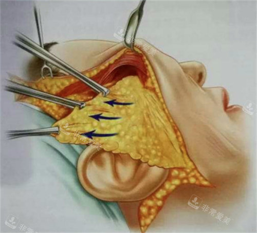 拉皮手术手术图