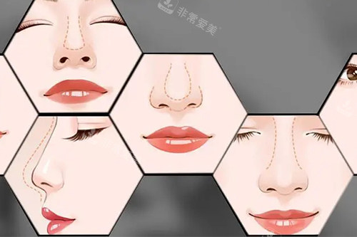 隆鼻后<span style=