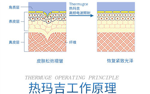 热玛吉工作原理展示图