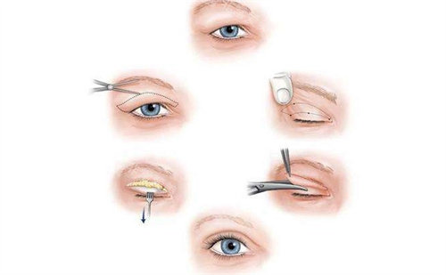 双眼皮手术流程图
