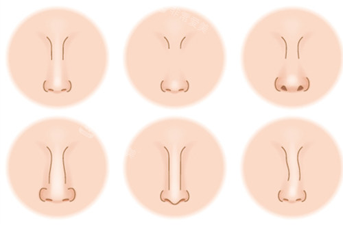 可以隆鼻的鼻型