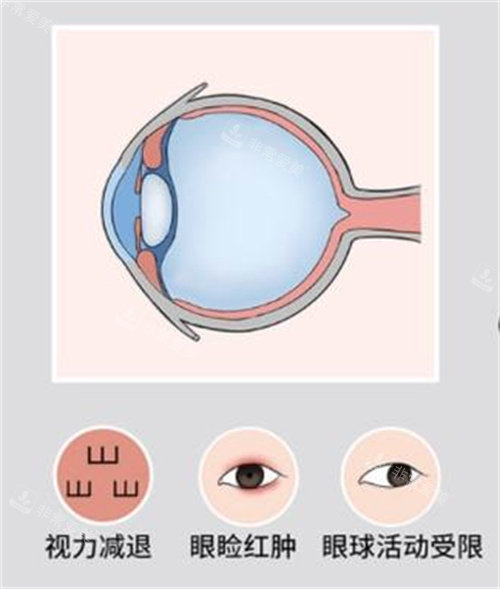 突眼癥狀 突眼癥狀
