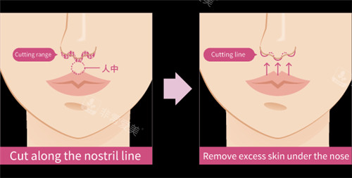 人中縮短手術(shù)原理圖