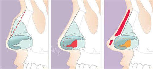 鹰钩鼻整形手术动画解析图