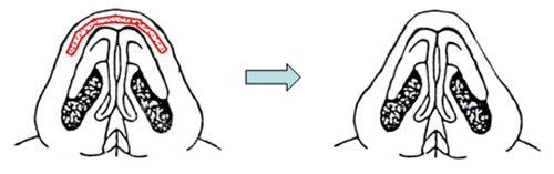 cocoline整形鼻子整形動(dòng)畫(huà)原理圖