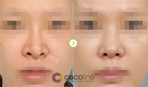 cocoline整形肋骨鼻手术图