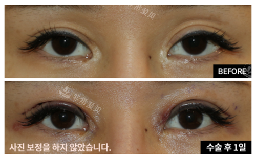 韩国当地人认可的眼修复医院是哪家?爱护医院官网图片分享