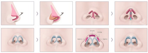 鼻修复手术流程图