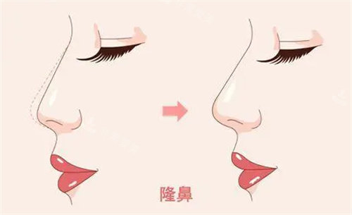 隆鼻前后對比圖