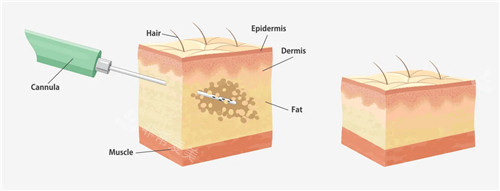抽脂手术原理图