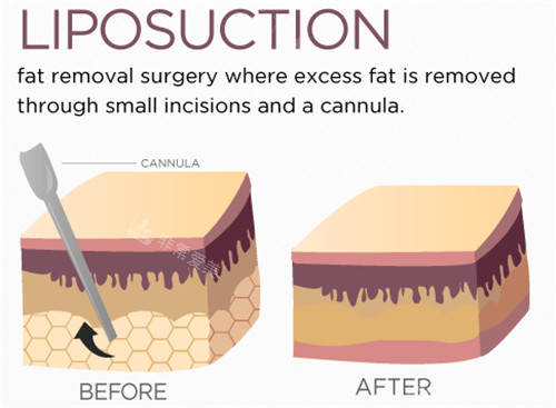 吸脂手术图