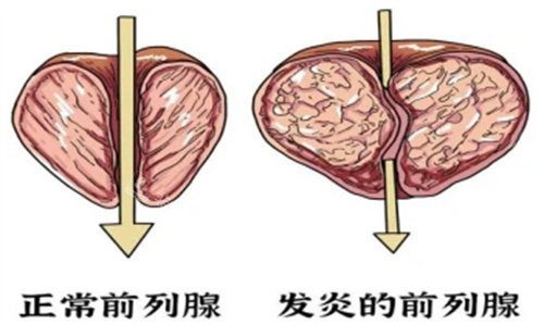 前列腺展示圖