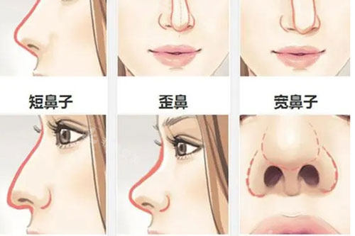 隆鼻鼻头变大