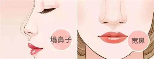塌鼻子和宽鼻动画图 塌鼻子和宽鼻动画图