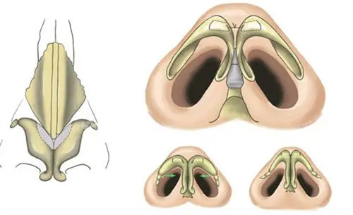 鼻翼縮小圖