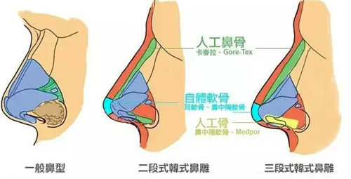 鼻型图