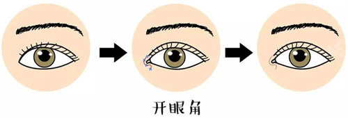 开眼角图片 开眼角图片